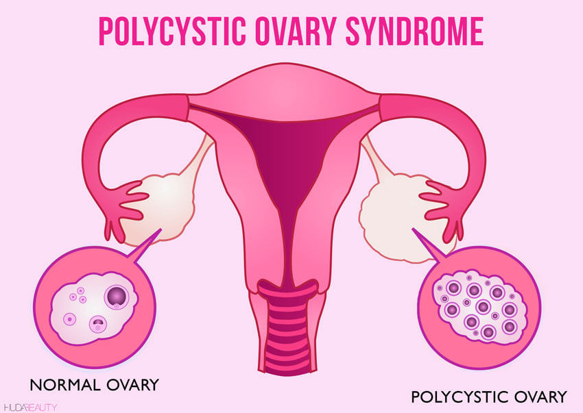 pcos